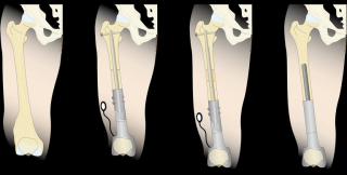 Wachstumsprothese